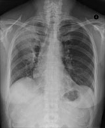 Image of CXR-pneumonia