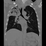 Image of CT thorax TB