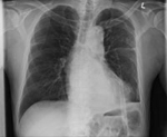 Image of CXR chest tube